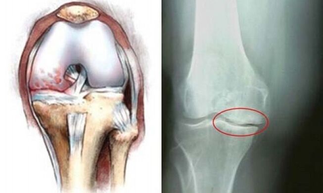 артроза на колянната рентгенова снимка