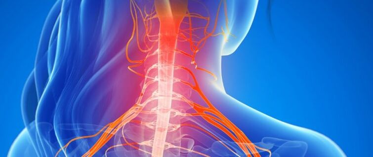 Компресиране на съдовете на гръбначния мозък при остеохондроза на шийните прешлени