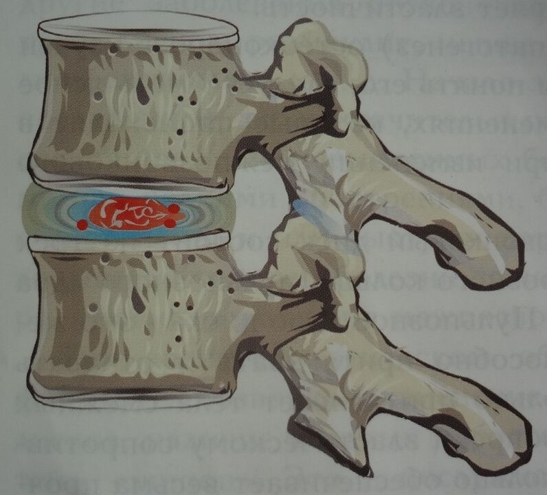 Увреждане на пулпозното ядро ​​на междупрешленния диск в първия етап на цервикална остеохондроза