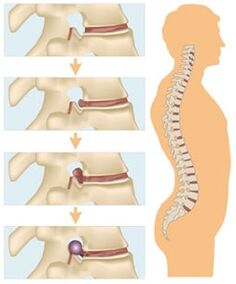 Четири етапа на развитие на цервикалната остеохондроза