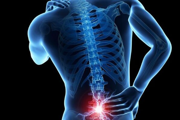 Острата болка в долната част на гърба е симптом на изместване на междупрешленните дискове