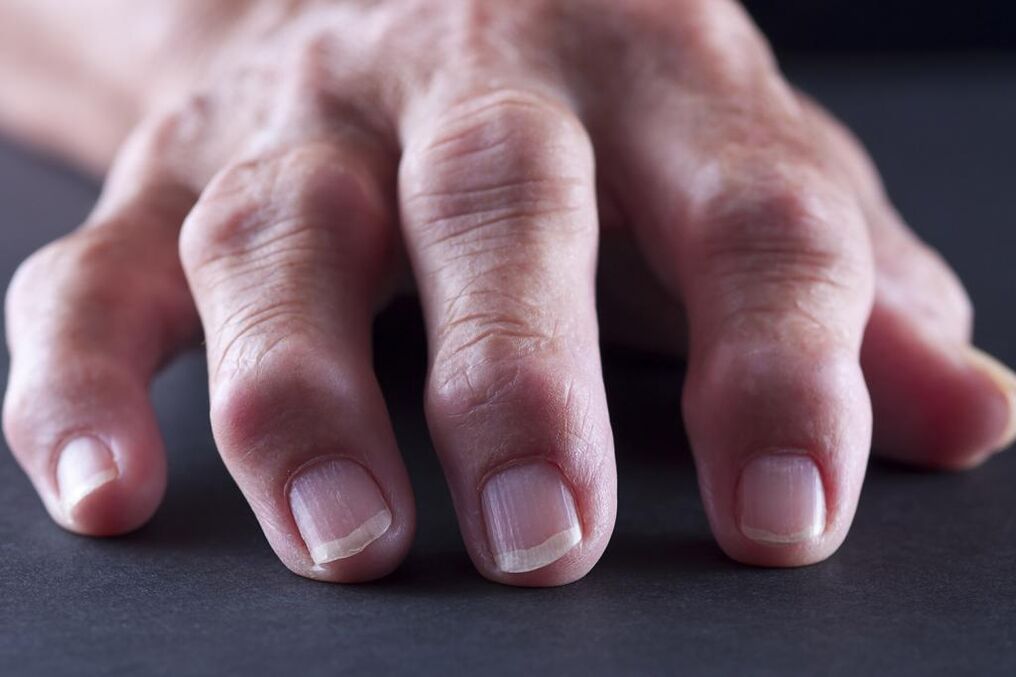 Бурситът се характеризира с болка, възпаление и подуване на ставите на пръстите