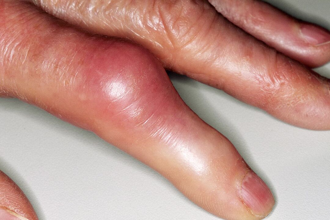 Подуване, деформация на ставата на пръста и остра болка след нараняване
